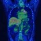 Imaging - NM  PET