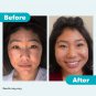 Proactiv+ 3 Step Advanced Skincare Acne Treatment  -30 Day Complete Acne Skin Care Kit