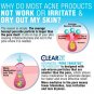 Clear Zit Acne Treatment Kit, 3 Step Pore Targeting System