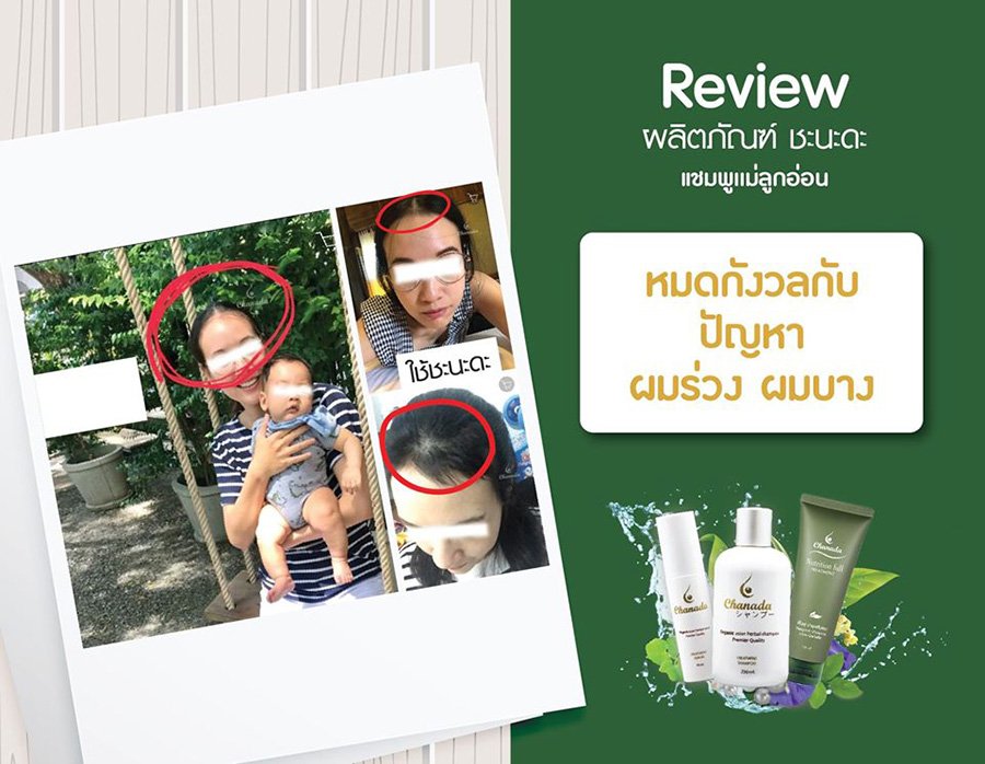 REGROW SHAMPOO REGROW HAIR LOSS REGROWTH CHANADA BREAST FEEDING WOMEN