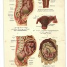 1890 - pregnancy pregnant pregnancy chromo lithograph lithograph