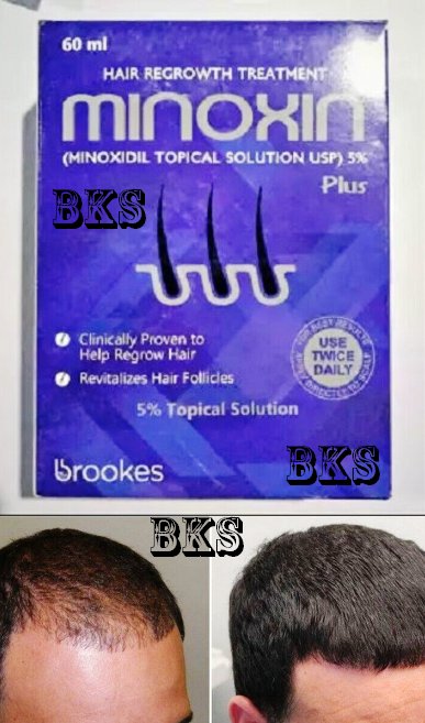 Minoxin Minoxidil 5 Extra Best Solution Of Strength Men Hair Regrowth Follicle 1198