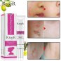 Scar Removal Acne Scar Treatment Cream Scar Repair Acne