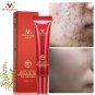 Crema Tratamiento Para ACNE Cicatrices Y Espinillas Limpia TU ROSTRO Facil