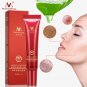 Crema para el acné que puedes eliminar fácilmente ¡Ten un rostro impecable