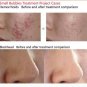 Water Peel Peeling Deep Face Cleansing Hydro Dermabrasion Hydra Facial Machine