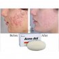 10 pcs ACNE-AID Face & Body Soap Bar Oil Control 100g For Acne Prone and Oily Skin