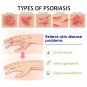 Psoriasis Dermatitis Eczema Natural Cream Skin Treatment Ointment FREE SHIPPING