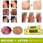 Herbal Eczmea Antibacterial Dermatitis Psoriasis Cream Anti-itch Skin Allergy Ringworm Itching