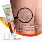 3 pcs set Genital Scrotum Varicocele Remover Treatment Varicose Veins Cream Varicosity Angiitis