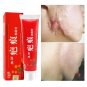 Acne Scar Removal Cream Pimples Stretch Marks Face Gel Remove