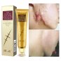30g Acne Scar Removal Cream Pimples Stretch Marks Face Gel Remove