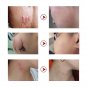 30g Acne Scar Removal Cream Pimples Stretch Marks Face Gel Remove