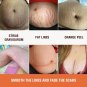 Maternity Stretch Marks Removal Cream Body Buttock Breast Mark Skin Care