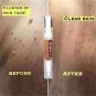 Skin Tag Remover Medical Against Moles Removal Genital Wart Acne Spot Treatment