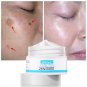 Freckle Whitening Face Cream Remove Melasma Pigment Melanin Acne Scar Dark Spots