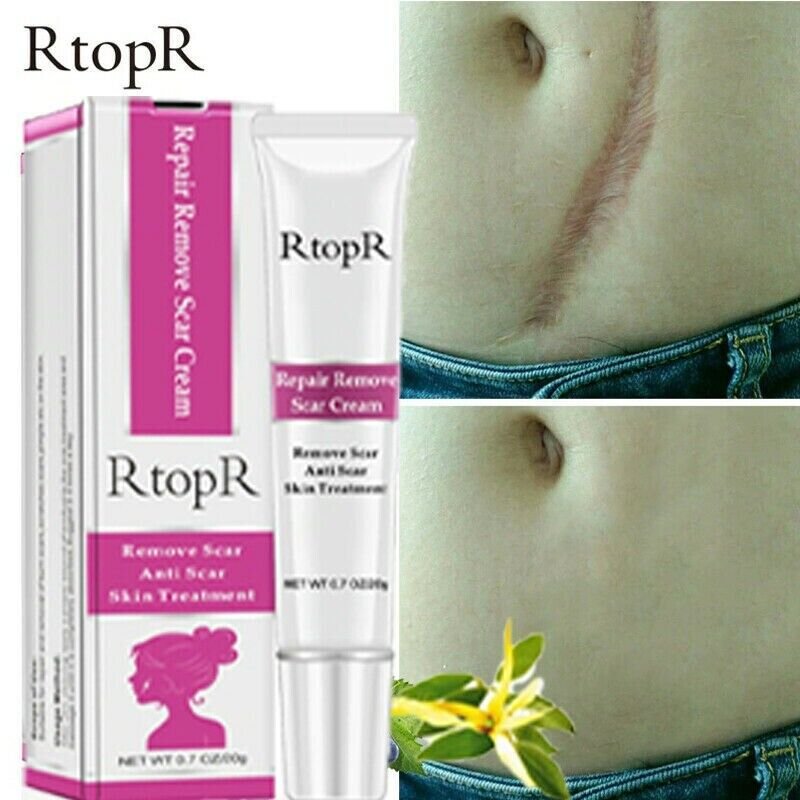 Crema Para Cicatrices Descubre Hoy Como Lucir Un Hermoso Rostro Libre De Marcas