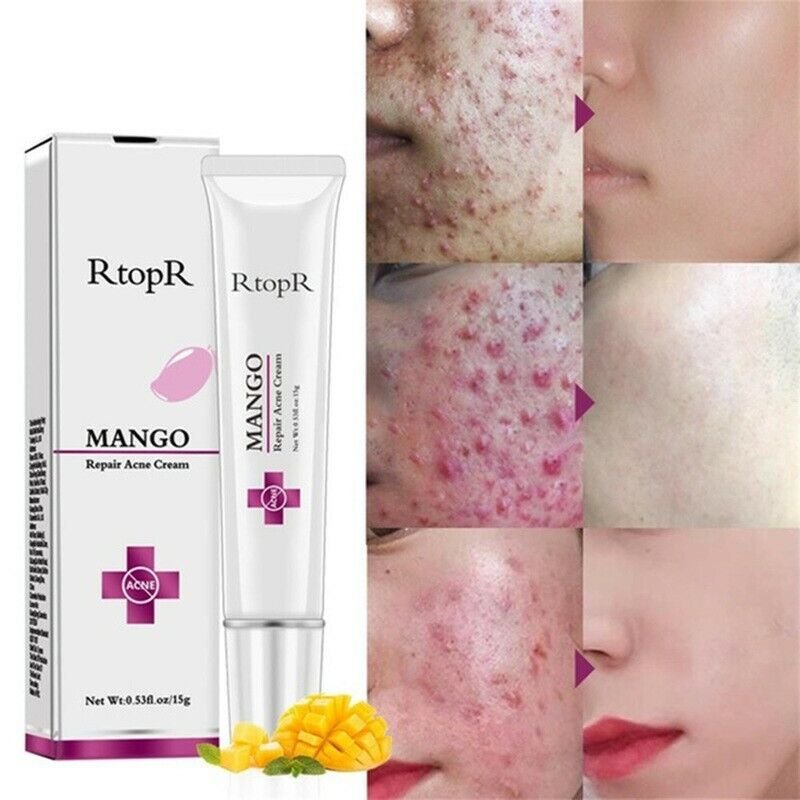 Rtopr Pimple Scar Acne Mark Spots Removal Treatment Gel Ointment Blemish Cream