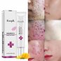 Rtopr Pimple Scar Acne Mark Spots Removal Treatment Gel Ointment Blemish Cream