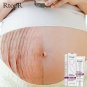 Crema Para Eliminar Estrias Previene Estrias En Abdomen Senos En El Embarazo