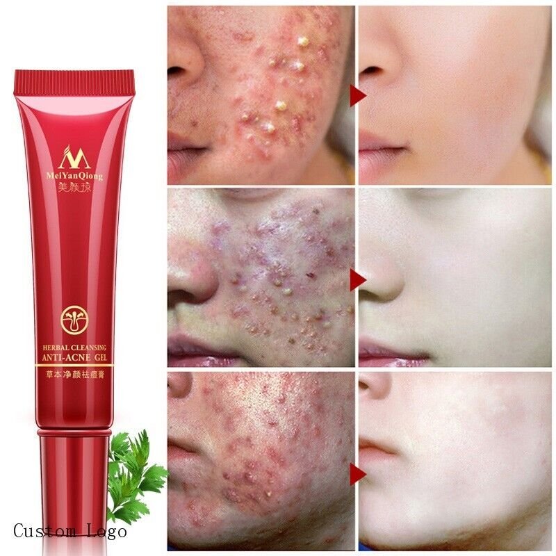 Crema Para El Acne Tu Puedes Eliminar El Acne Facil Y Lucir Un Rostro Impecable!