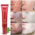 Crema Para El Acne Tu Puedes Eliminar El Acne Facil Y Lucir Un Rostro Impecable!