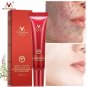 Crema Para El Acne Tu Puedes Eliminar El Acne Facil Y Lucir Un Rostro Impecable!