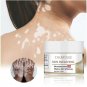 CHUMOLEE WHITE SPOT CREAM DARK KNUCKLES BLEACHING CREAM VITILIGO