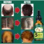 3 x Aceite De Jengibre Para Detener La Caida Del Cabello Estimula El Crecimiento