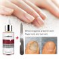 2 Pack Anti Fungal Nail Treatment Nail Finger Toe Fungus Onychomycosis Remover