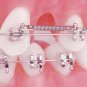 2 Pack (4)  Niti Open Coil Springs 0.012"/ 0.014" / 0.010" x 180mm  Dental Orthodontic  Materials