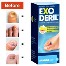 5 PACK Exoderil %1 Mycosis, Candida, Skin Corrugation Fungus Remedy 20 ML