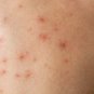 4 PACK Fenistil Gel Relieves Itching Skin Rashes Insect Bites Sunburns Local Tr