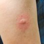 4 PACK Fenistil Gel Relieves Itching Skin Rashes Insect Bites Sunburns Local Tr