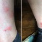 4 PACK Fenistil Gel Relieves Itching Skin Rashes Insect Bites Sunburns Local Tr