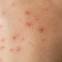 4 PACK Fenistil Gel Relieves Itching Skin Rashes Insect Bites Sunburns Local Tr