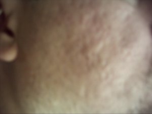 acne gone forever