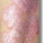 13-OIL SCAR/RASH OIL®, , shea butter, poison ivy, absorbs EASILY giving you better results-FASTER