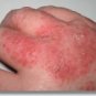 13-OIL SCAR/RASH OIL®, , shea butter, poison ivy, absorbs EASILY giving you better results-FASTER