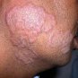 13-OIL SCAR/RASH OIL®, , shea butter, poison ivy, absorbs EASILY giving you better results-FASTER