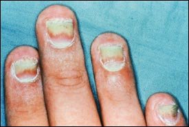 NAIL FUNGUS TREATMENT OIL®-natural oils with shea butter, pedicure, manicure, hand