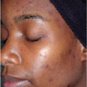 OILY/ACNE-PRONE SKIN KIT I&Acirc;&reg; -egyptianpearl series-OMA' shea butter-pimples-blackheads-acne
