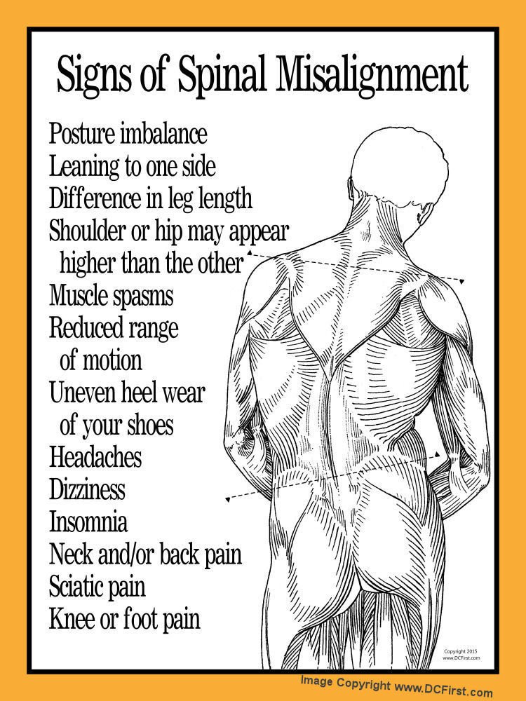 Signs of Spinal Misalignment Poster Wall Chart Chiropractic 18 X 24