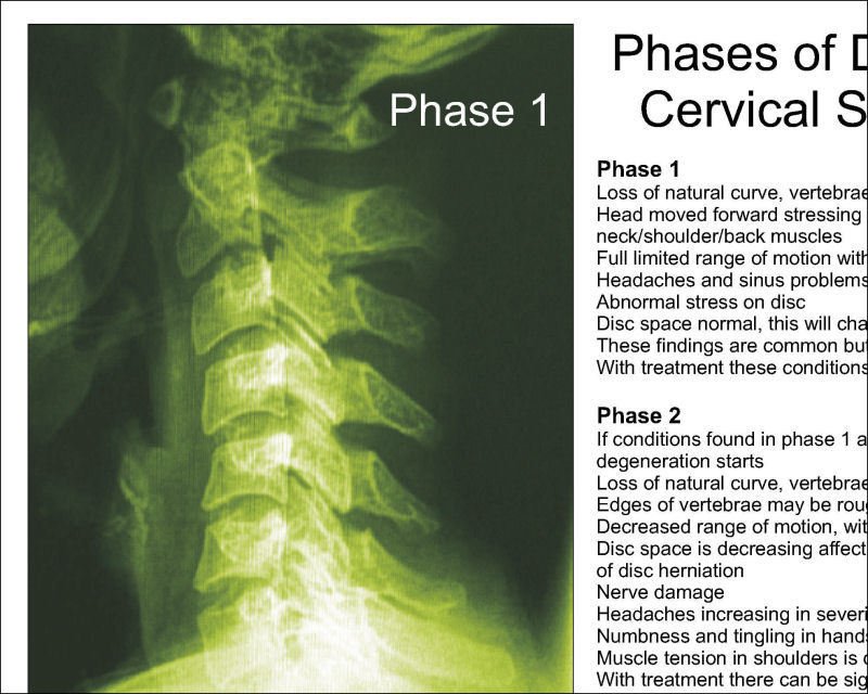 Phases Cervical Spinal Degeneration Poster 18