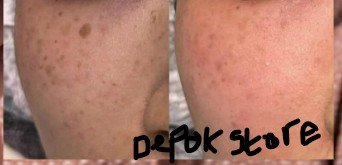 4 Box Niaclear treat acne, dark spots, skin barrier Niacinamide alcohol free