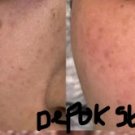4 Box Niaclear treat acne, dark spots, skin barrier Niacinamide alcohol free