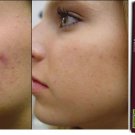 Mederma for Skin Care Scars STRETCH MARK REMOVAL ACNE BURN Treatment 10 GM