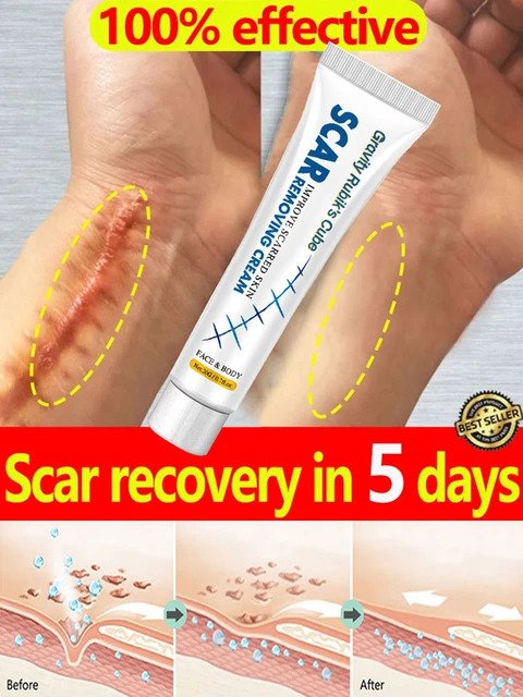 scar removal cream for old scars