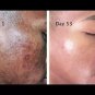 2 x B TEX Cream 14g For Skin Problems Eczema Ringworm Blemishes & Pimples