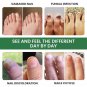 Nail Fungal Lacquer 2.5ML FREE & FAST DELIVERY